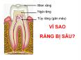 Vì sao rang bị sâu?