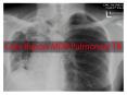 R. L. (Bob) Cowie, Health Research & Innovation Centre -- Case Report MDR Pulmonary TB
