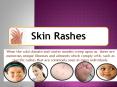 Frequent Winter Rashes and Skin Disorders - Fully grasp Some Typical Rash Troubles