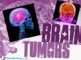 Most Advanced Brain Tumor Treatment available at World Class  Hospitals in India
