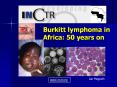 Burkitt lymphoma in Africa: 50 years on Ian Magrat