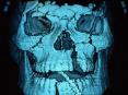 Spine Instability Slide 33 Slide 34 Slide 35 Cervical Spin