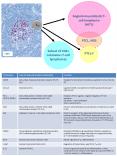 Angioimmunoblastic T-cell lymphoma (AITL) TFH PTCL, NO