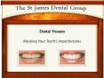 Dental Veneers: Cover your Teeth's Imperfections with Dental Veneers