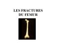 LES FRACTURES DU FEMUR 1-FRACTURE DE L EXTREMITE SUPERIEUR