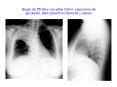 Mujer de 55 a os con sdme febril, expectoraci n purulenta