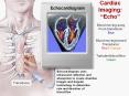 Cardiac Imaging:  Echo  Blood moving away From transduce