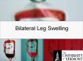 Bilateral Leg Swelling History CC: Bilateral leg swellin