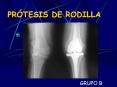 pr tesis de rodilla grupo b  ndice 1. introducci n a
