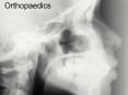 Orthopaedics Fractures-Principles Factors that influenc