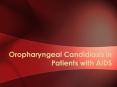 Oropharyngeal Candidiasis in Patients with AIDS Cas