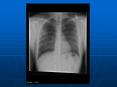 Organizing Pneumonia Catherine Hathaway AM Report 8/20/0
