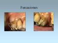 Furcaciones Anatomia dentaria Complejo radicular Tronc