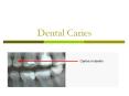 Dental Caries Dental caries destroy the mineral component o