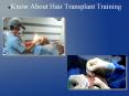 Know about hair transplant