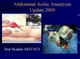 Abdominal Aortic Aneurysm Update 2009 Paul Skudder MD FAC