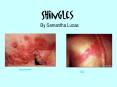 The blisters follow the path of individual nerves that come