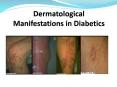 -Small percentage of patients with diabetes develo