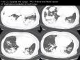 F 69, CC: Dyspnea and cough PHx: Asthma and Rectal cancer CT: Multiple consolidation in both lungs