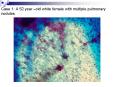 Case 1: A 52 year old white female with multiple pulmonary nodules