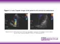 Magnoni M et al' 2007 Reduction of mitral valve regurgitation caused by acute papillary muscle ische