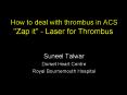 How to deal with thrombus in ACS "Zap it" Laser for Thrombus