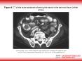 ZuberJerger I et al' 2005 Diagnosis and treatment of a patient with gallstone ileus