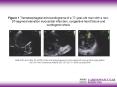 Mallidi HR and Latter DA 2006 Ventricular pseudoaneurysm associated with severe mitral regurgitation