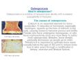 Osteoporosis What is osteoporosis Osteoporosis is a condition of reduced bone density with increased