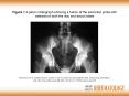 Monnet D et al' 2006 Severe uveitis in an HLAB27positive patient with ankylosing spondylitis