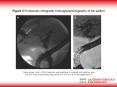 ZuberJerger I et al' 2005 Diagnosis and treatment of a patient with gallstone ileus