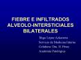 FIEBRE E INFILTRADOS ALVEOLOINTERSTICIALES BILATERALES