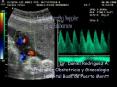 Ecotomografia Doppler en el Embarazo
