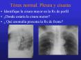 Trax normal' Pleura y cisuras