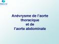 Anvrysme de laorte thoracique et de laorte abdominale