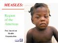 MEASLES: