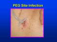 PEG Site Infection