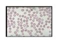 Peripheral smear