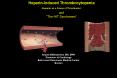 Understanding HeparinInduced Thrombocytopenia HIT: Historical and Clinical Perspectives
