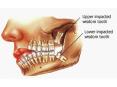 What are the causes behind removing wisdom teeth?